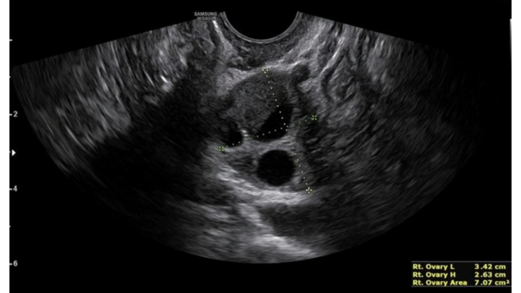 Endometrioma con evidencia del característico doble nivel líquido-líquido. Dentro de la formación, se pueden observar puntos hiperecogénicos, síntoma de acumulación de hemosiderina.