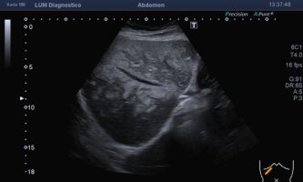 Ecografía de segmentos hepáticos derechos, reconociéndose imágenes focales ecogénicas confluentes, de distribución perivascular, sin efecto de masa.