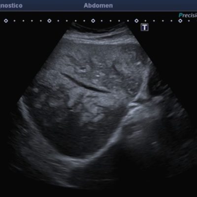 Ecografía de segmentos hepáticos derechos, reconociéndose imágenes focales ecogénicas confluentes, de distribución perivascular, sin efecto de masa.