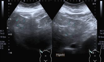 Figura 10. Ecografía de segmentos hepáticos izquierdos, observándose múltiples focos ecogénicos, que resulta difícil su caracterización por este método de estudio.