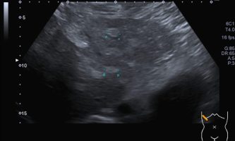 Figura 11. Ecografía de domo hepático de mismo paciente, apreciando un importante numero de lesiones focales ecogénicas de pequeño tamaño.