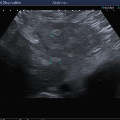 Figura 11. Ecografía de domo hepático de mismo paciente, apreciando un importante numero de lesiones focales ecogénicas de pequeño tamaño.