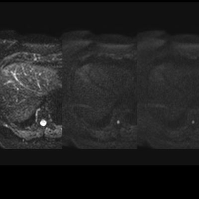 Figura 13. RM. Secuencias difusión del mismo paciente con valores de b, 0-400-800, sin focos de restricción que sugieran la presencia de metástasis.