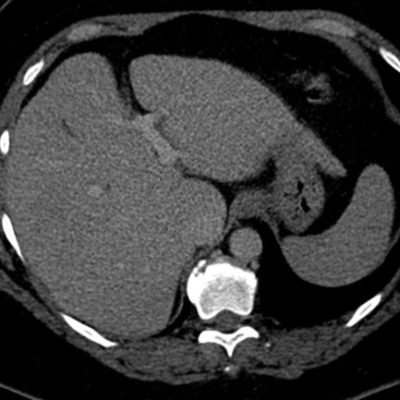 Figura 14. TC hepática del mismo paciente en tiempo portal post contraste endovenoso, sin evidencia de imágenes sospechosas.
