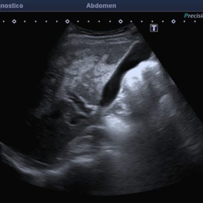 Figura 2. Ecografía hepática, con lesiones peri vesiculares de distribución y morfología no habitual.