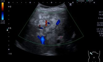 Figura 3. Ecografía Doppler color del lóbulo hepático derecho, no reconociéndose vascularización peri ni intra lesional de sospecha.