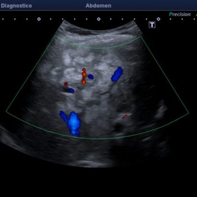 Figura 3. Ecografía Doppler color del lóbulo hepático derecho, no reconociéndose vascularización peri ni intra lesional de sospecha.