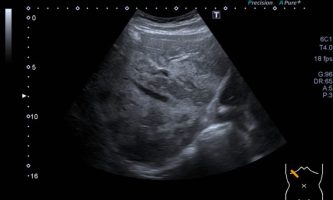 Figura 4. Ecografía del lóbulo derecho observándose calibre habitual de venas supra hepáticas, sin efecto de masa de lesiones ecogénicas confluentes adyacentes.