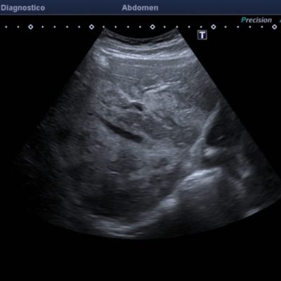 Figura 4. Ecografía del lóbulo derecho observándose calibre habitual de venas supra hepáticas, sin efecto de masa de lesiones ecogénicas confluentes adyacentes.