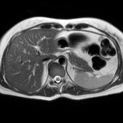 Figura 6. RM potenciada en pulsos T2, observándose un parénquima homogéneo, sin lesiones focales.