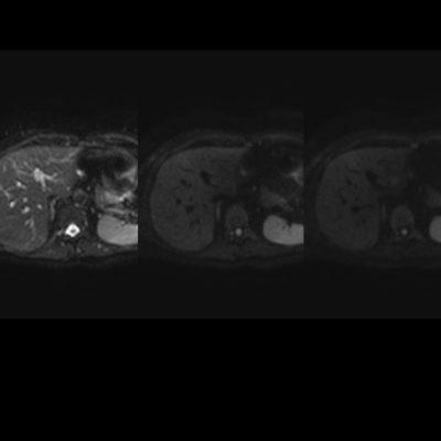 Figura 7. RM en secuencias difusión con valores de b, 0-400-800, sin áreas focales ni difusas de restricción que sugieran la presencia de lesiones benignas hepáticas, infecciosas o metastásicas.