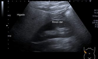 Figura 8. Ecografía hepática, con aumento difuso de la ecogenicidad del parénquima. Se reconoce la diferencia de ecogenicidad con la corteza renal adyacente.