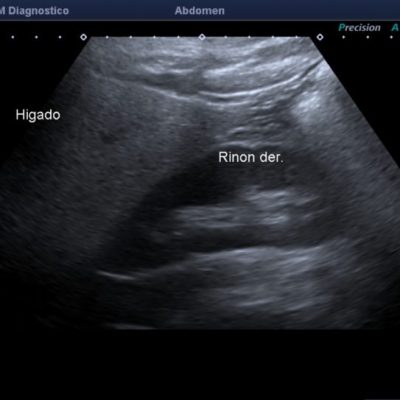 Figura 8. Ecografía hepática, con aumento difuso de la ecogenicidad del parénquima. Se reconoce la diferencia de ecogenicidad con la corteza renal adyacente.