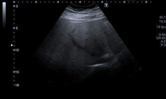 Figura 9B. Eco-Doppler de mismos segmentos, reconociendo la dirección y patrón habitual de la vena suprahepática media.