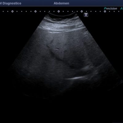 Figura 9B. Eco-Doppler de mismos segmentos, reconociendo la dirección y patrón habitual de la vena suprahepática media.
