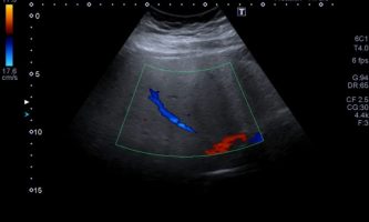 Figura 9a. Eco-Doppler de mismos segmentos, reconociendo la dirección y patrón habitual de la vena suprahepática media.